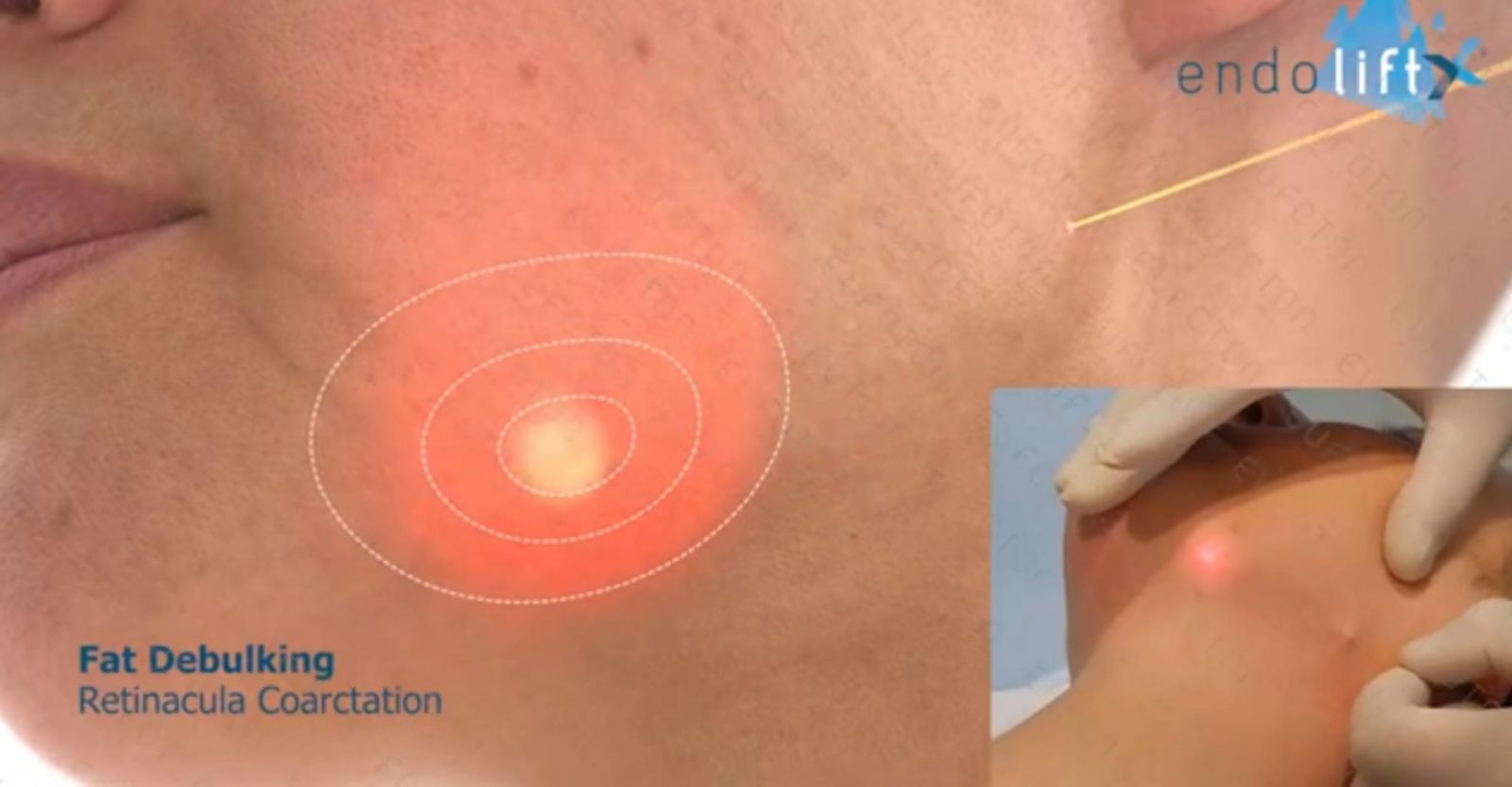 Así funciona ENDOLIFT: Lifting láser sin cirugía